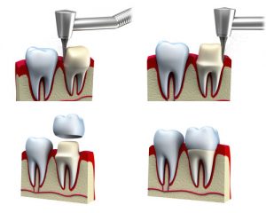dental crown installation process