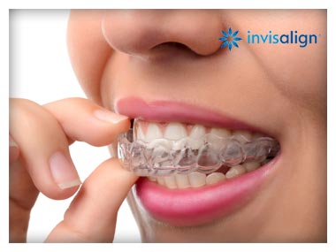 Invisalign Clear Braces System