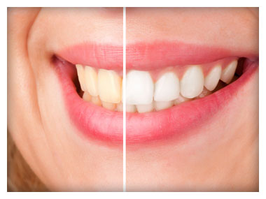 Professional Teeth Whitening Before & After